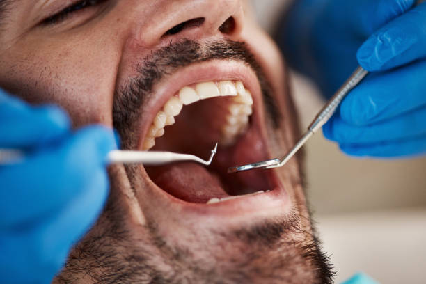 Best Emergency Treatment for Dental Infections or Abscesses in Redmond, WA